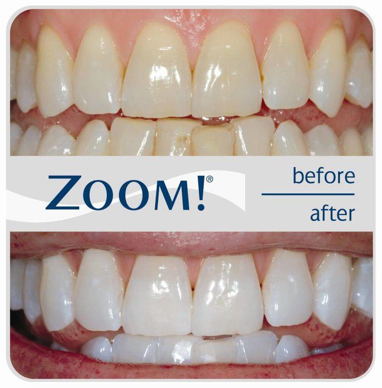 ZOOM teeth whitening service, brighter shades of white